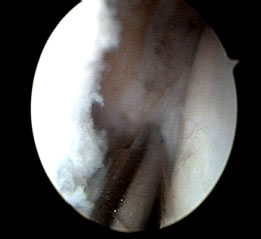 Ankle Arthroscopy