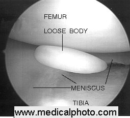 Arthroscopy Knee