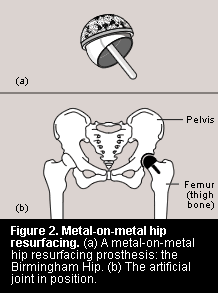 Birmingham Hip Resurfacing