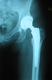 Hip Replacement