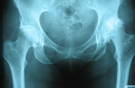 Hip Arthritis