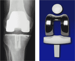 Revision Knee Replacement Implants