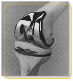 knee implants